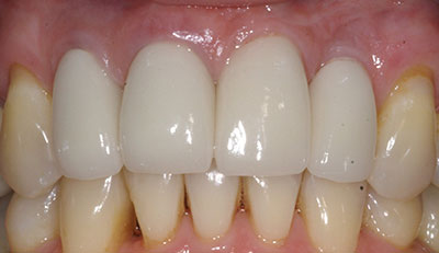 After picture of Dental Implant Placement and Crown Restoration