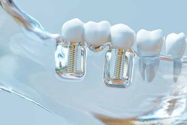 Multiple Tooth Implant mold in Encinitas, CA at Encinitas Periodontics & Dental Implants