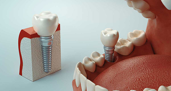 Rendering image of tooth socket graft at Michael Yokoyama, D.D.S in Encinitas, CA
