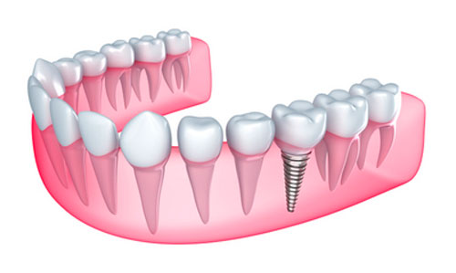 Does Having Dentures or Dental Implants Eliminate the Threat of Gum Disease?