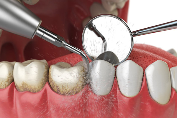 An example of periodontal maintenance at Encinitas Periodontics & Dental Implants in Encinitas, CA