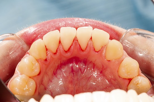 Effects Gum Disease Has Under Your Gumline