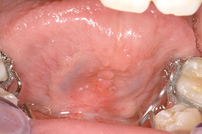 Img_Frenectomy_Frenum_after_c1671