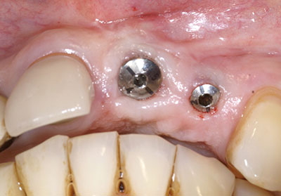 Img_THC_implants_before_c1671