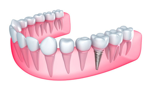 Who Is Suitable For Dental Implants?