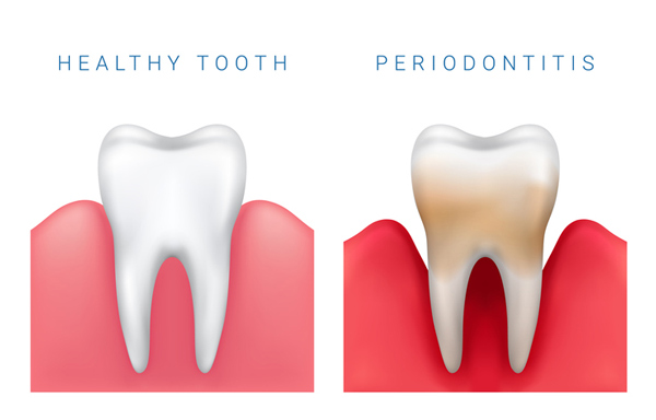 Tips For Care After A Deep Gum Cleaning