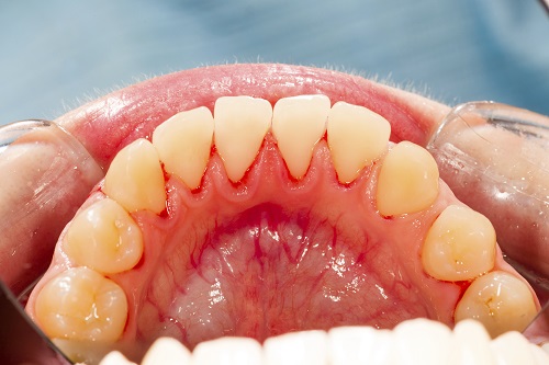 Understanding Four Stages Of Gum Disease